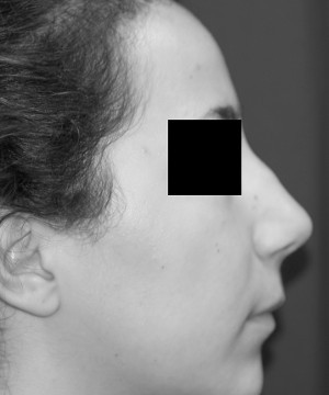 Rinoplastica su naso a gobba dopo l'intervento